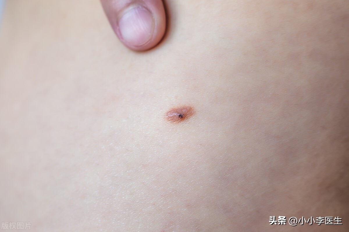 激光祛痣笔真的有用吗,冷冻祛痣好还是激光好