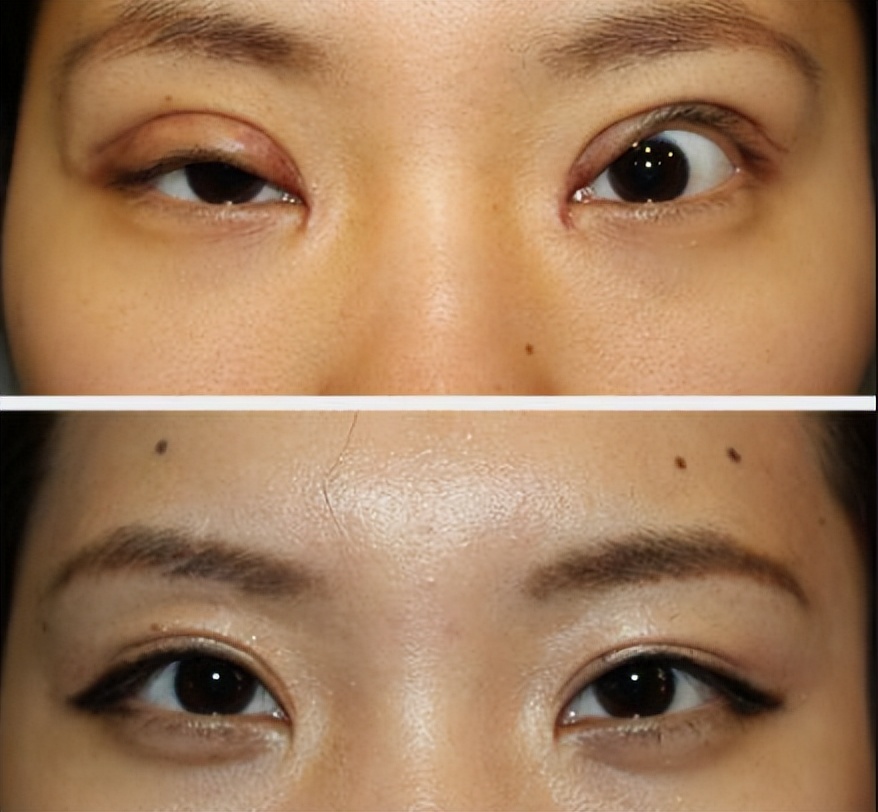 修复双眼皮七个月了人都说失败了,双眼皮失败修复的亲身经历