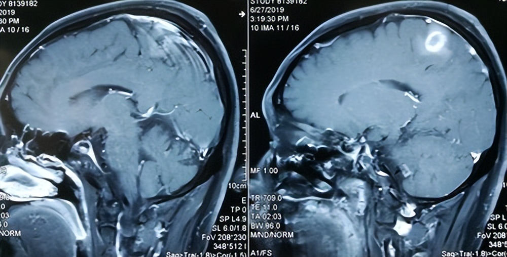 医生在患者清醒下进行开颅,脑子进血开颅手术