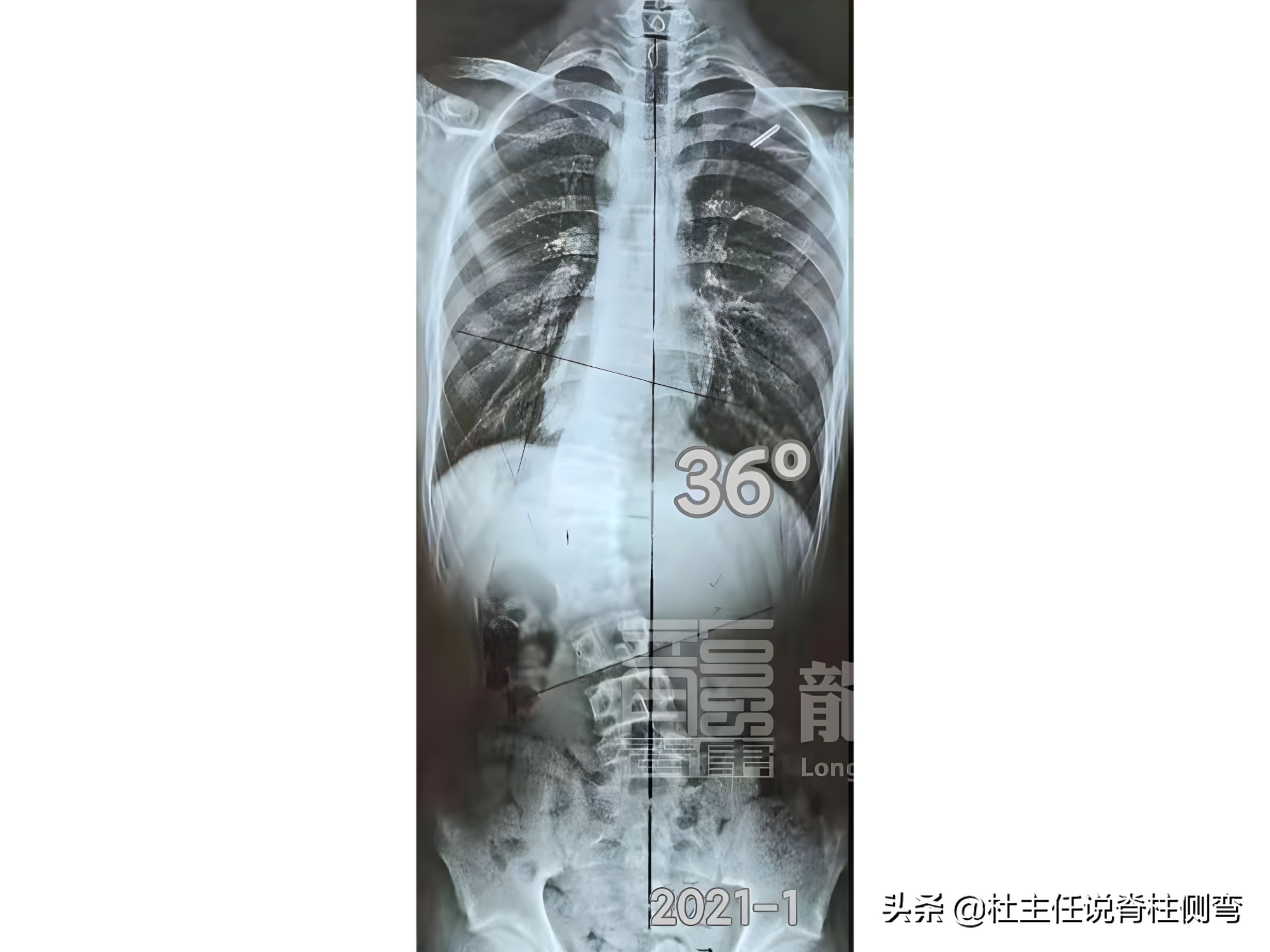 11至14岁青少年更易患脊柱侧弯,脊柱侧弯多少度会出现剃刀背