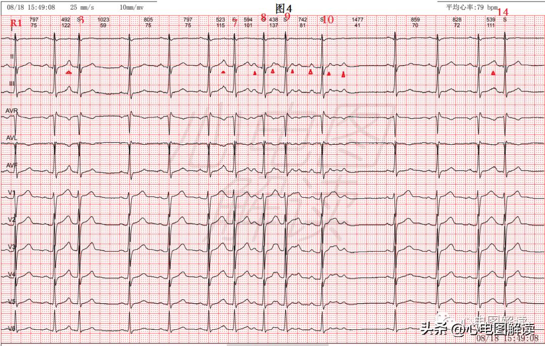 房早室早区别,房早室早房颤