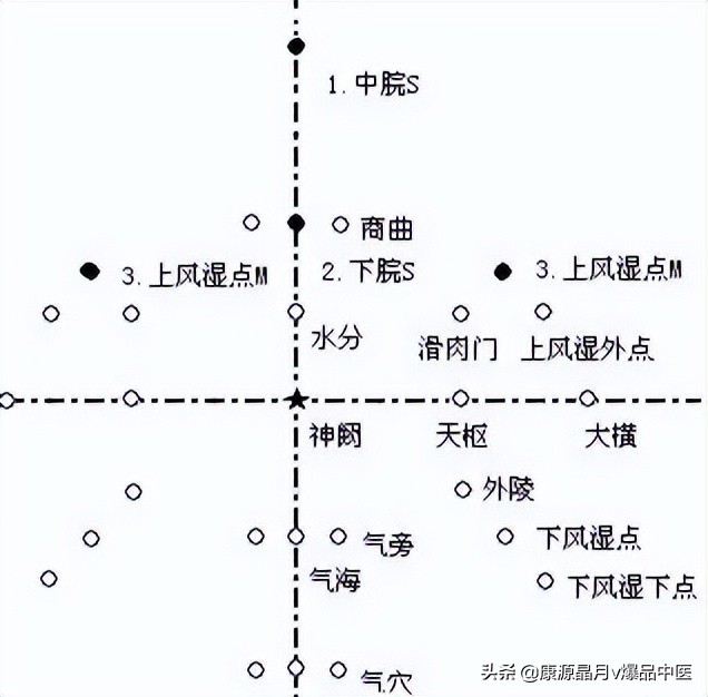 腹针疗法及16例常用处方