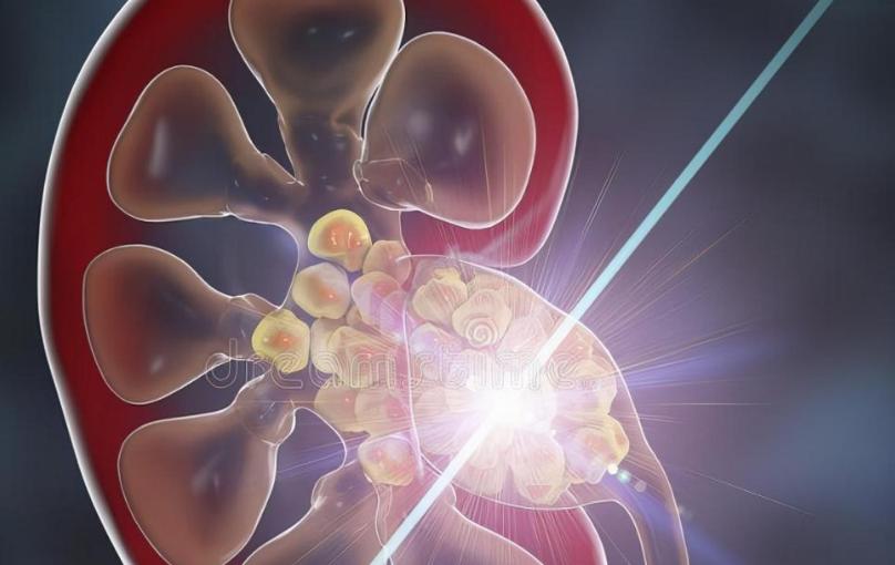 肾结石是什么病，治疗不及时会发生什么？术后护理需要注意些什么