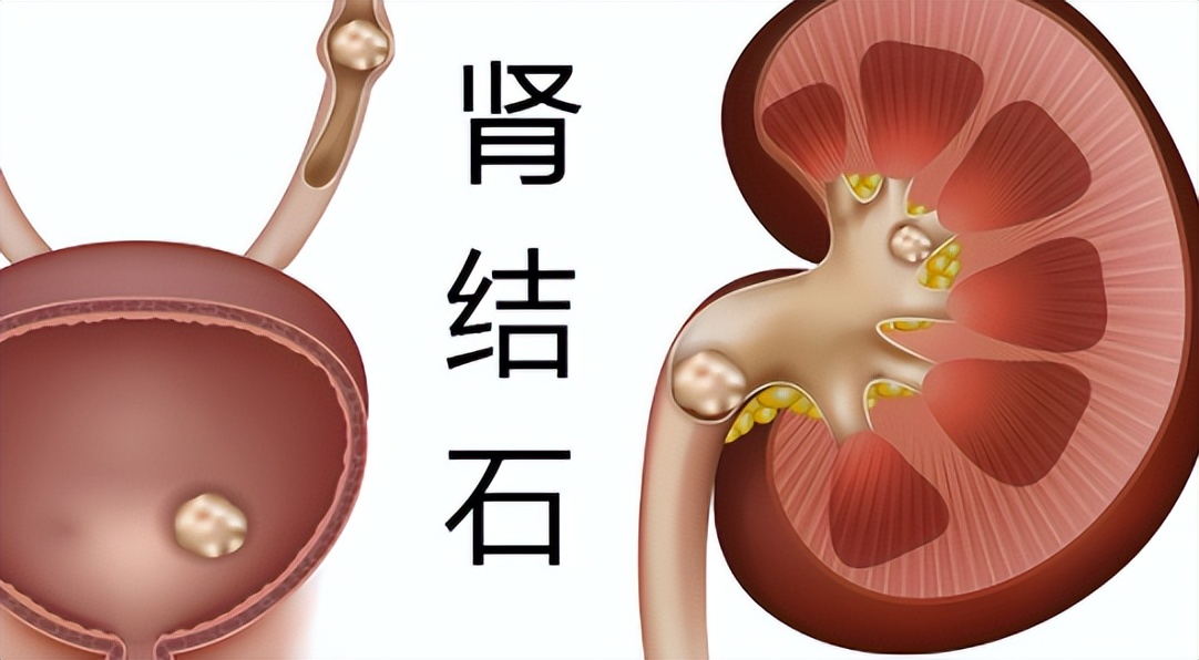 肾结石不能吃鸡蛋吗需要注意什么,肾结石鸡蛋不能吃还能吃什么