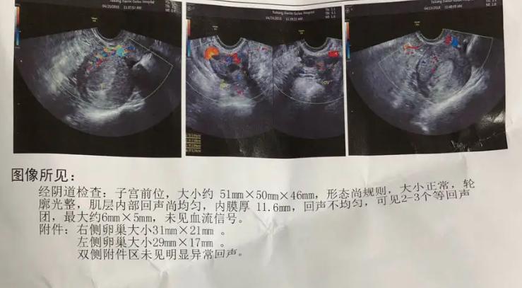 防止内膜息肉复发需要上曼月环吗,内膜息肉怎么防止复发备孕