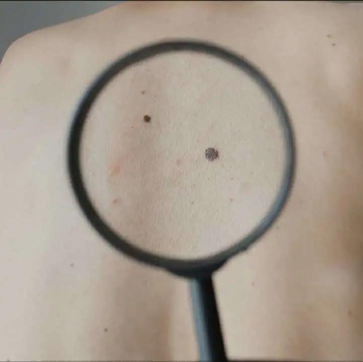 如何区别黑痣和黑色素瘤,怎样区别黑痣和黑色素瘤