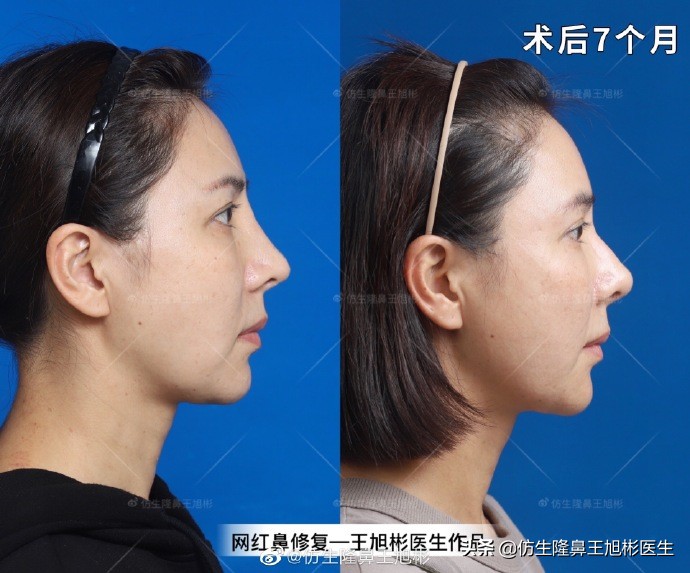 隆鼻太过于自然跟没做一样,隆鼻太自然和没做一样