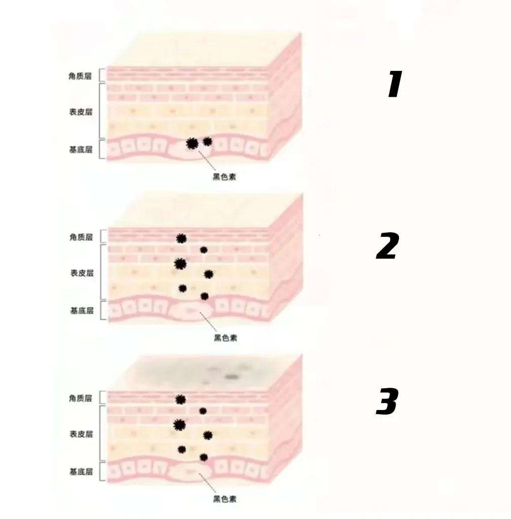 色斑形成的几个阶段和解决方法,色斑的形成原因及解决方法