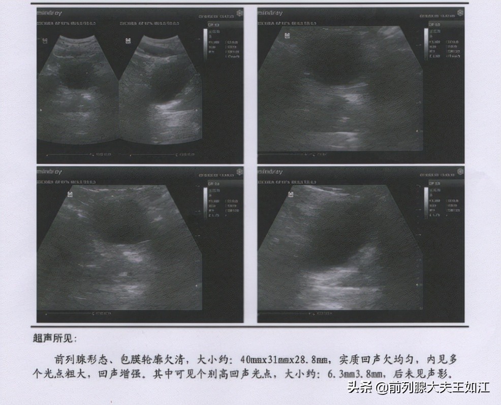 前列腺增大有必要做psa检查吗,检查前列腺还有必要验精吗