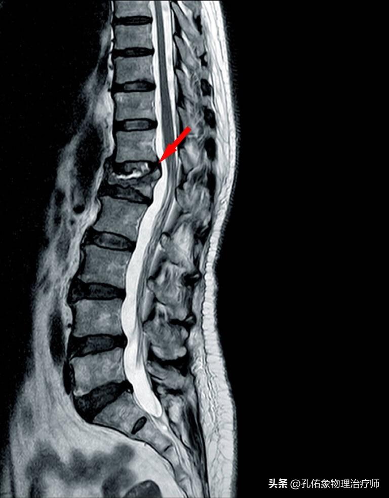 老年人压缩骨折能治好吗,腰椎压缩骨折腰部酸痛怎么办