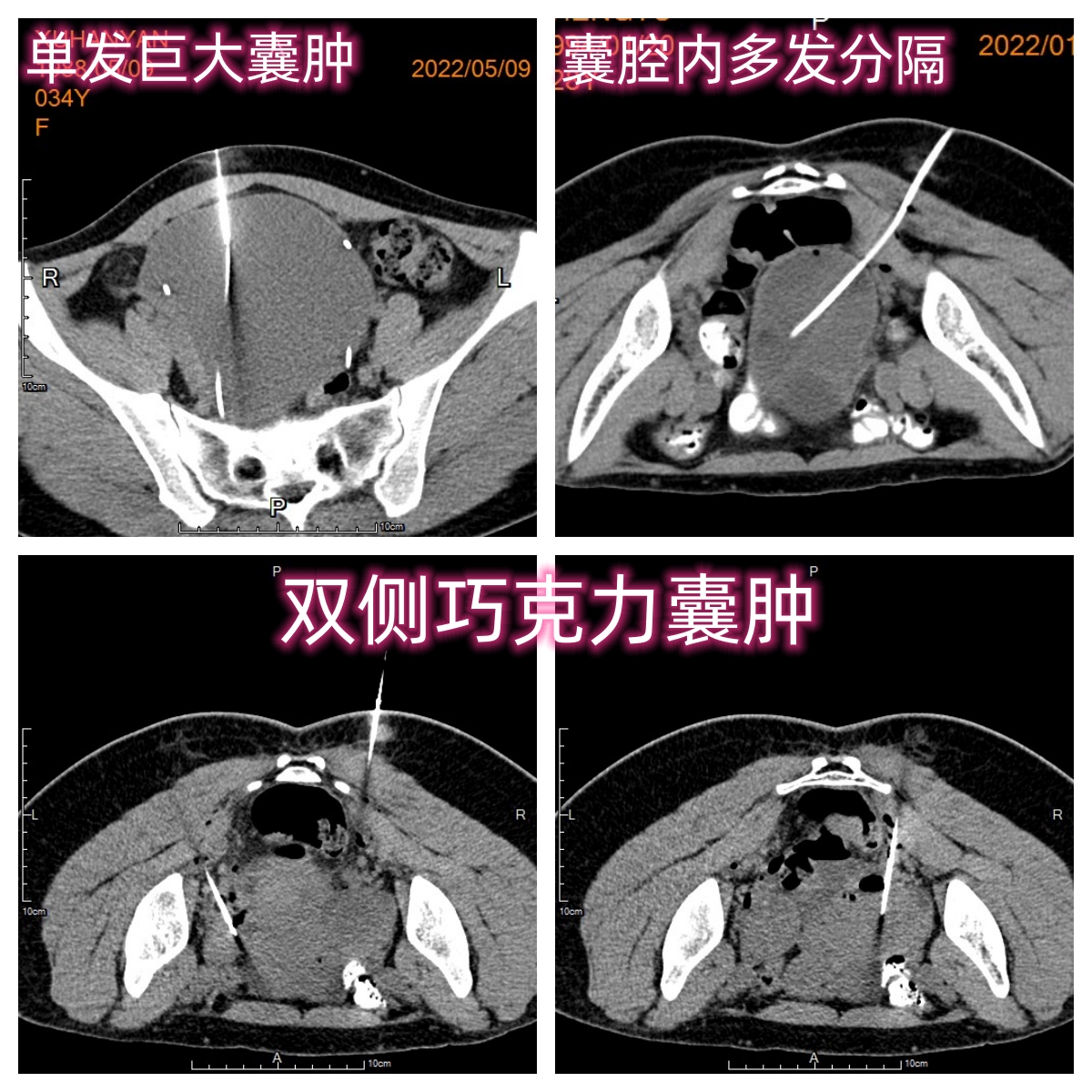卵巢巧克力囊肿介入穿刺硬化治疗后该如何长期管理？