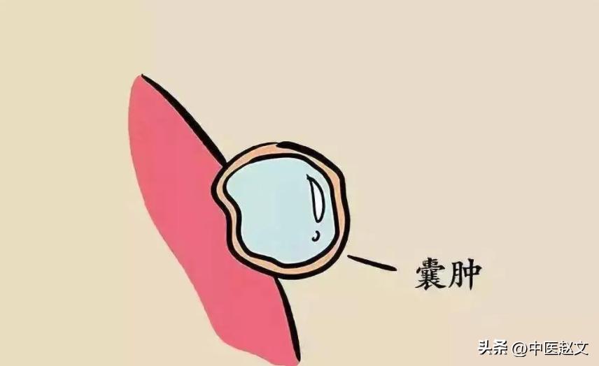 吃什么可以消囊肿结节,长了囊肿吃中药有什么治疗方法吗