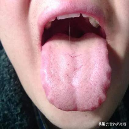 湿气要如何改善,湿气重怎么有效祛除湿气呢