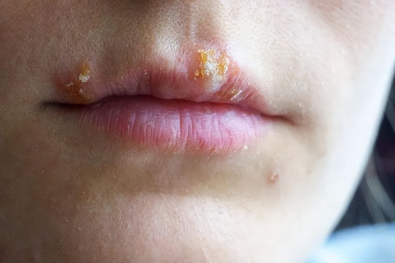 嘴上出了好多透明水泡会传染吗,嘴巴周围长了好多小水泡要忌口吗