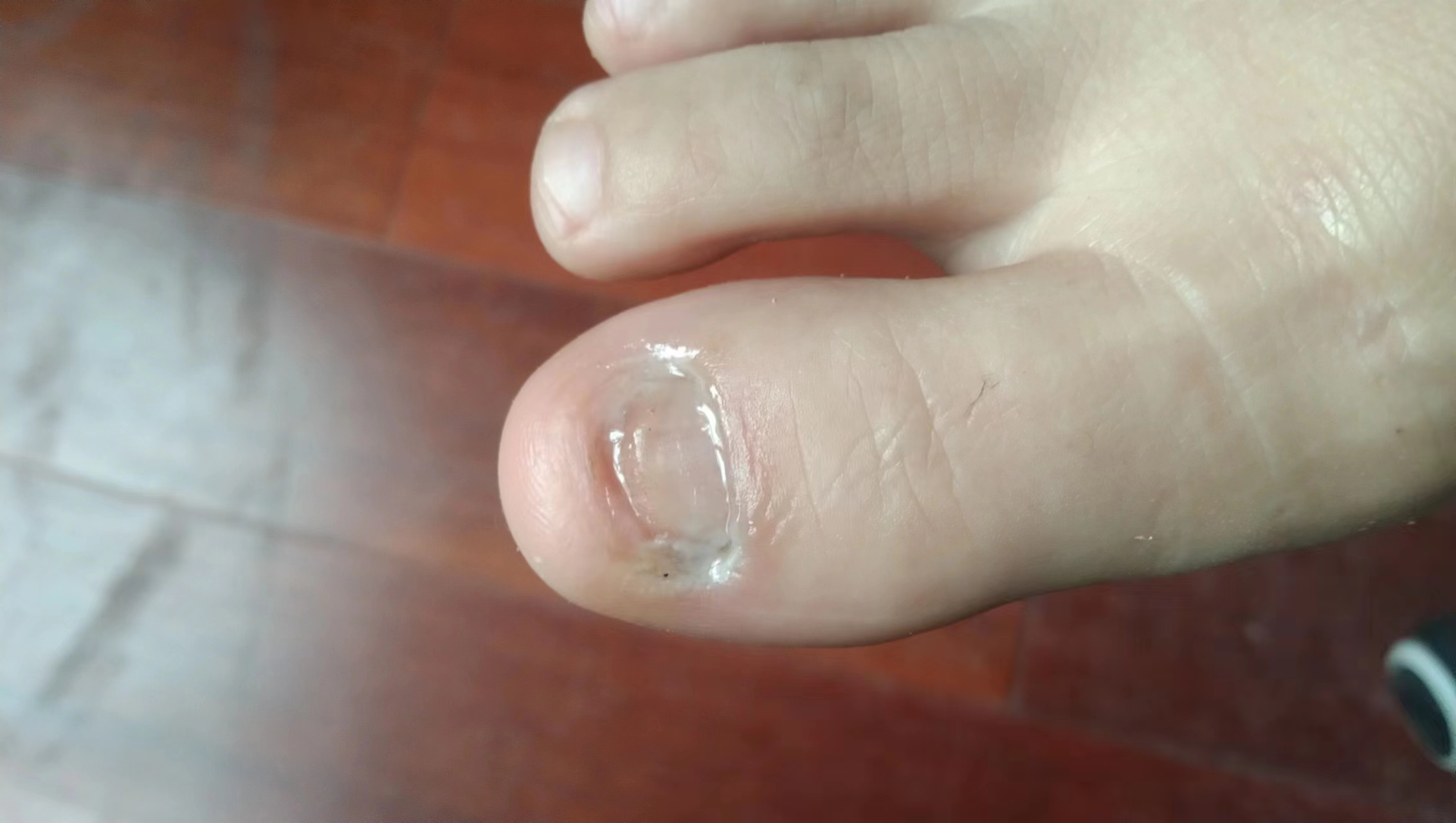 18年的灰指甲吃药有用吗,10年灰指甲能治愈吗