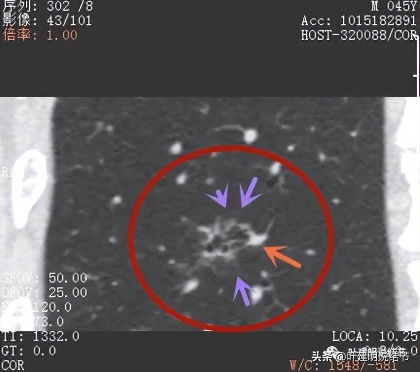 误诊肺纤维化,肺蜂窝状是癌吗