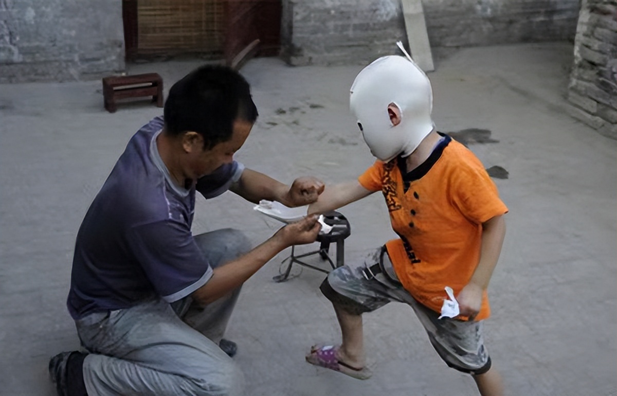 小孩被火烧伤戴面具,面具娃娃烧伤