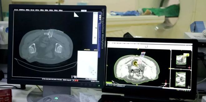 癌症不做化疗新方法细胞疗法,癌症早期不化疗用中药能治好吗