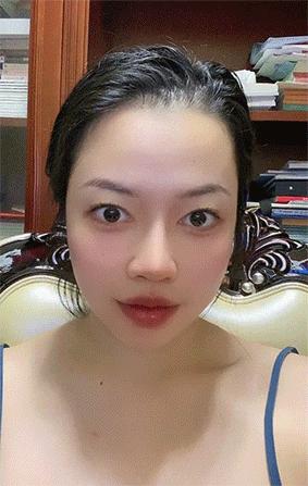 做膨体隆鼻感染了怎么办,膨体隆鼻注意事项