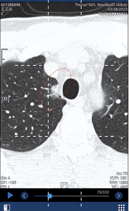 肺部磨玻璃结节0.5*0.4需要手术吗,肺部6mm*9mm的磨玻璃结节问题大吗