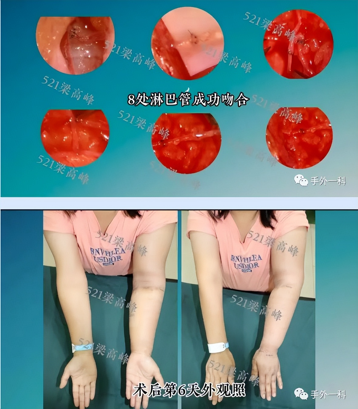 兵器工业521医院常规开展肿瘤术后淋巴水肿治疗手术