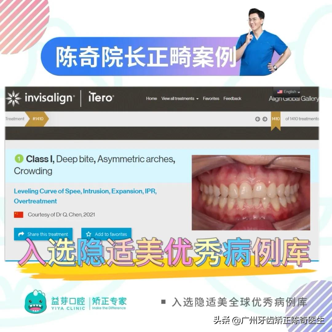 隐适美矫正和普通矫正的区别,隐适美矫正有几种版本