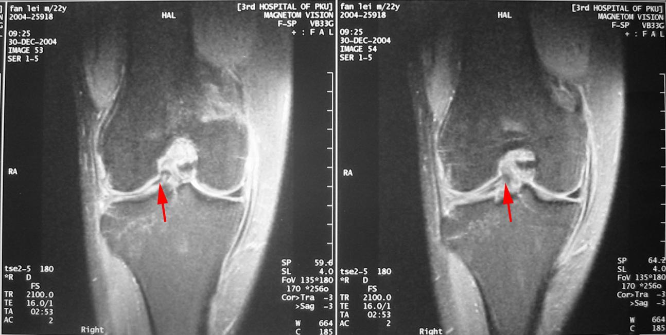 膝关节酸胀疼痛无力怎么治疗,膝关节外侧酸胀痛伸不直