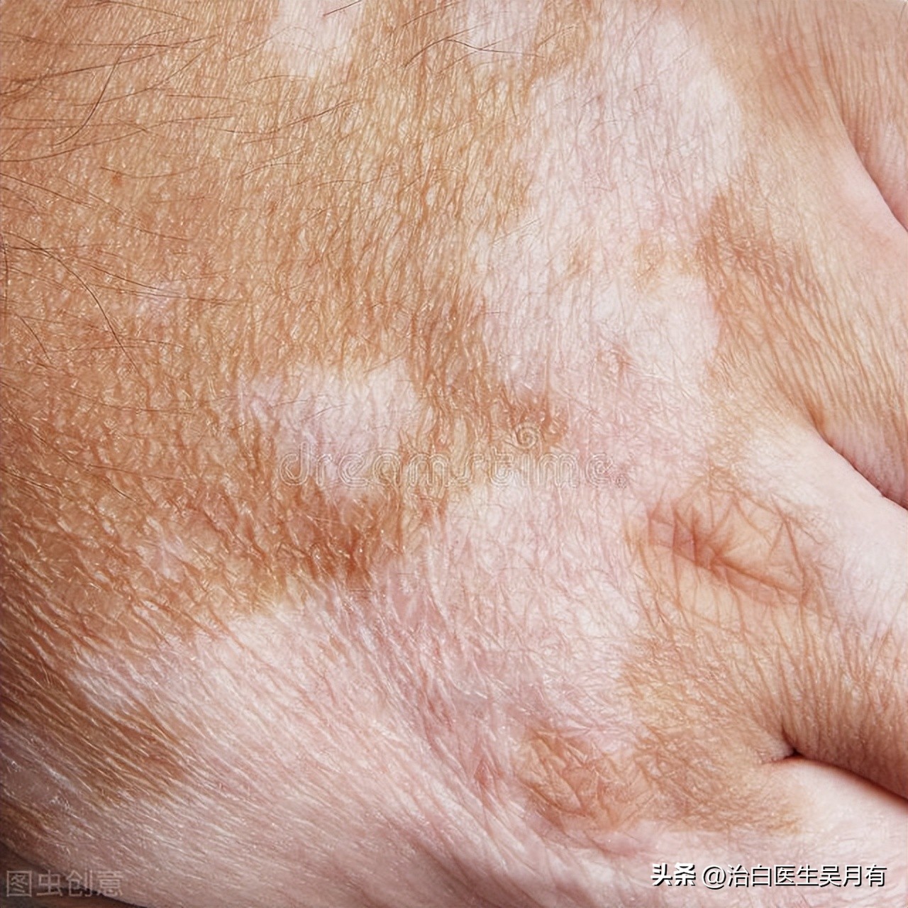 早期白癜风多久见效,早期白癜风需要多久能治好