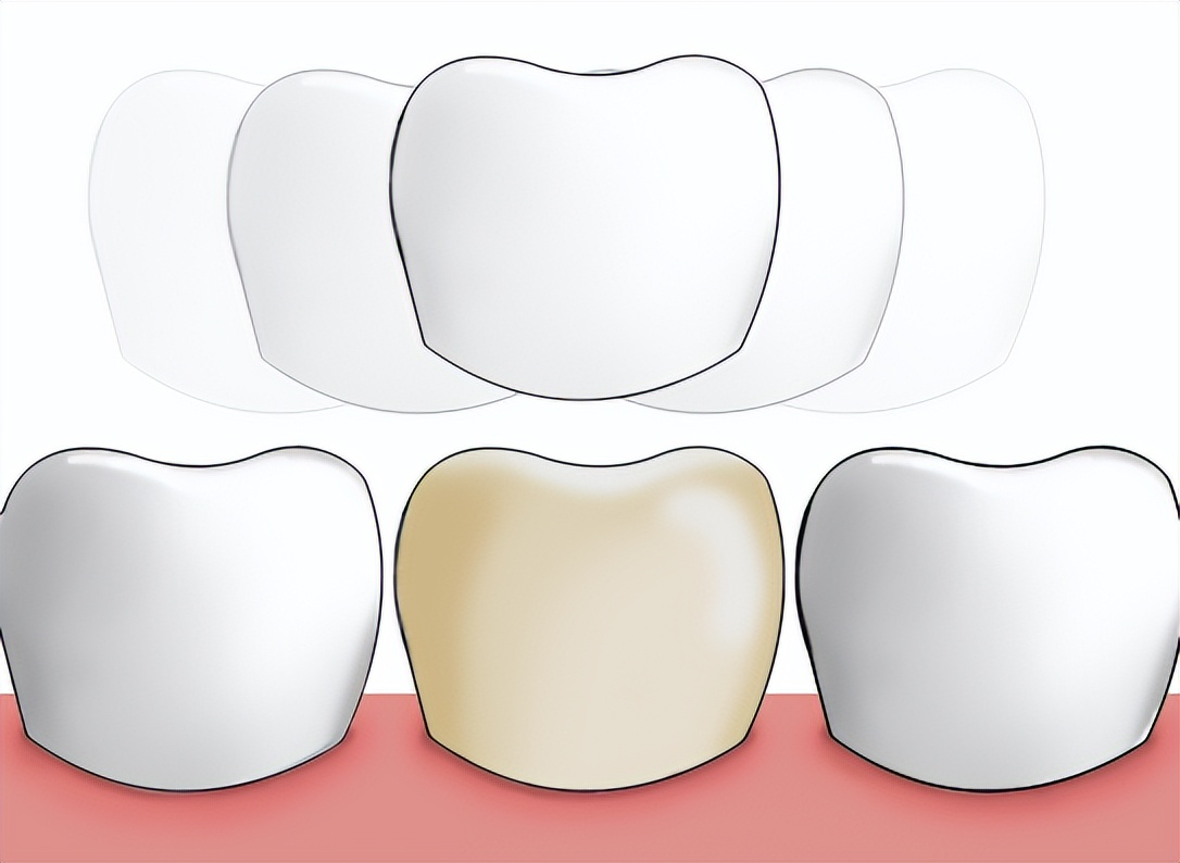 牙齿美白技术有哪些冷光美白,冷光美白牙齿后变黄了