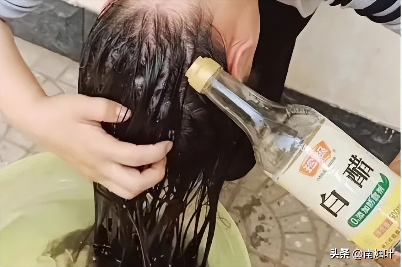 头油头痒头屑掉头发怎么治疗,头屑多头皮痒油头有什么好妙招