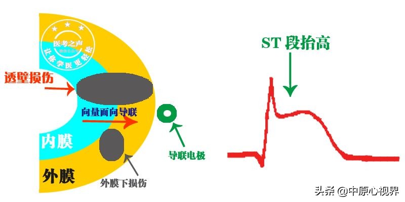 护考几种常见的心电图,常见的心电图图形分析
