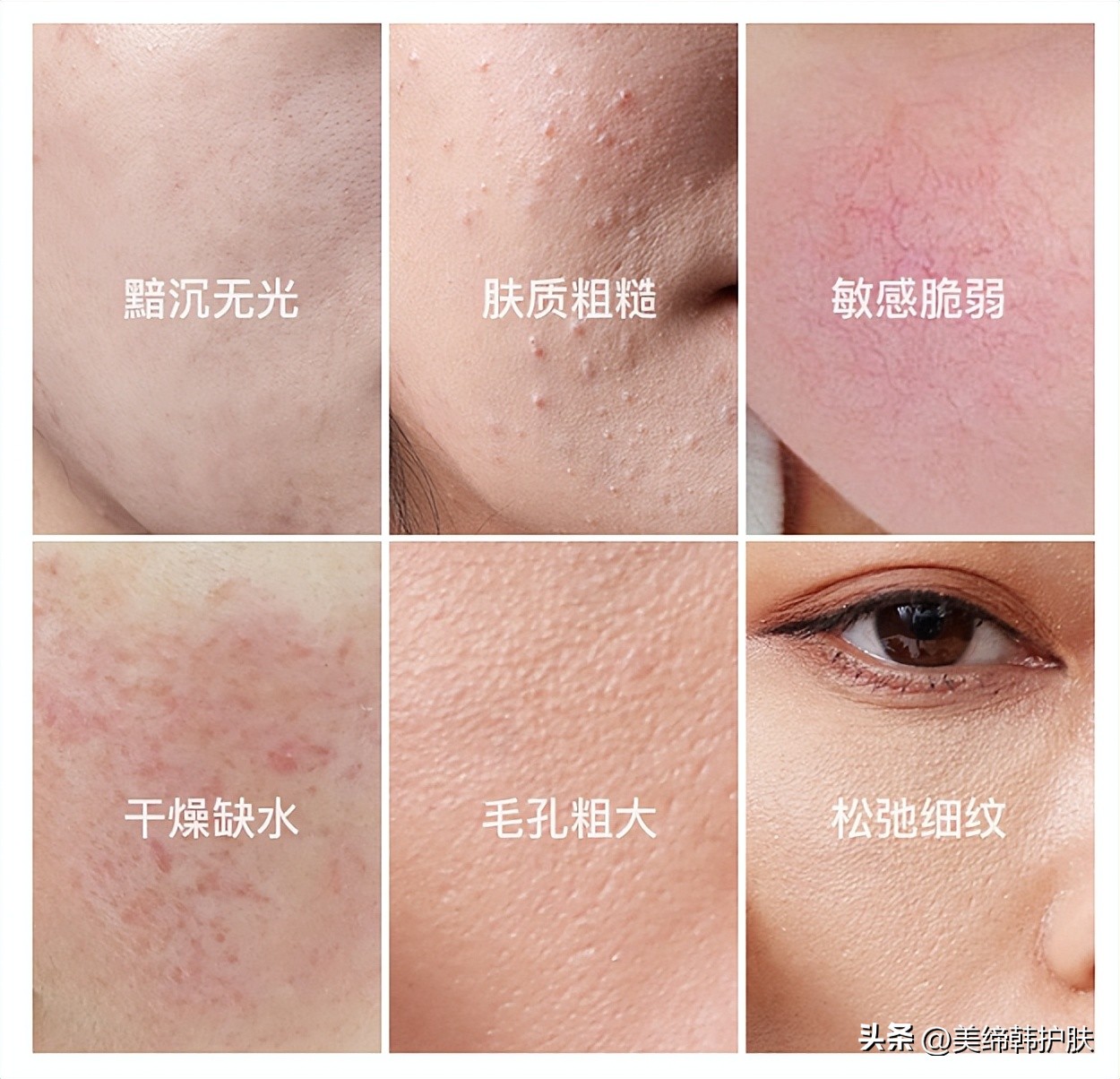 红血丝敏感肌夏天怎么护肤,敏感肌的正确护肤方法