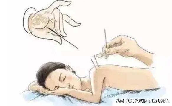 身上一燥热就像针扎一样刺痒,身上像针扎一样的感觉还有小红点