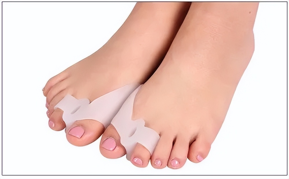 大脚拇外翻走路如何矫正,大脚趾歪了怎么矫正