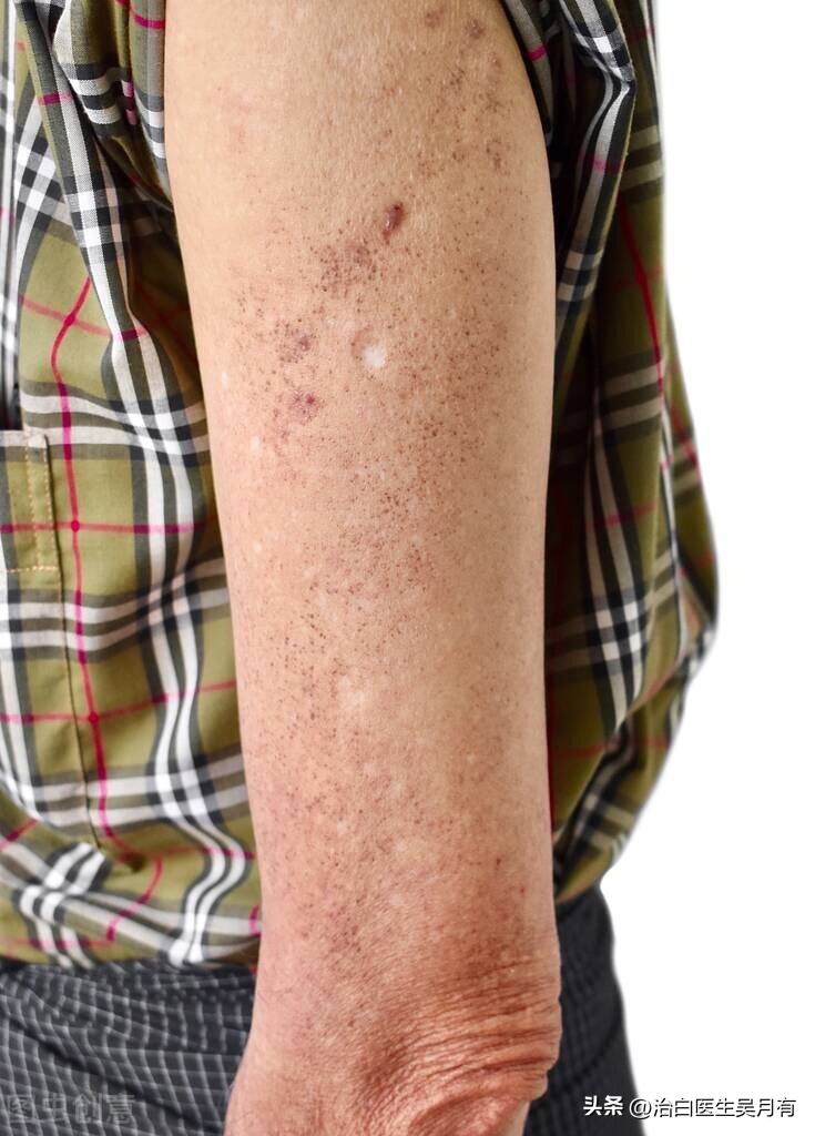 各种斑与白癜风的区别,所有的白斑都是白癜风