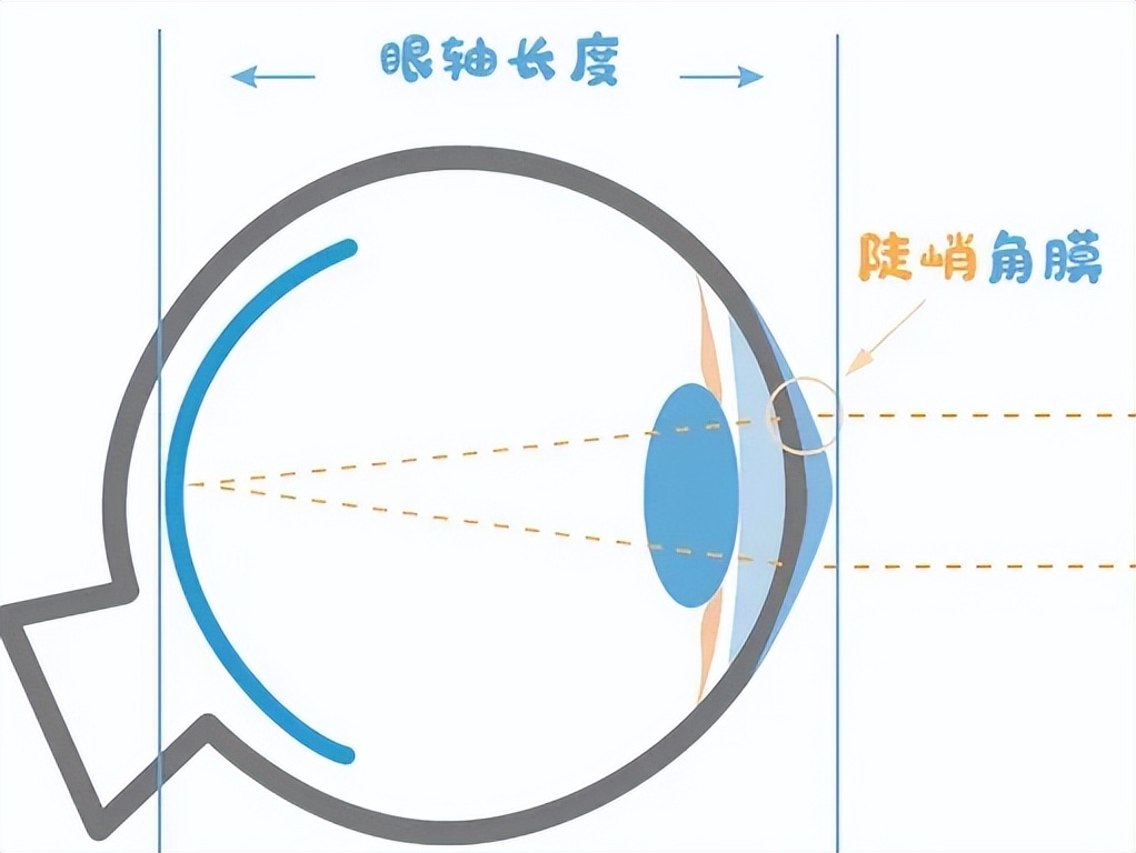 10岁孩子眼轴正常一年长多少,孩子的眼轴能恢复正常吗
