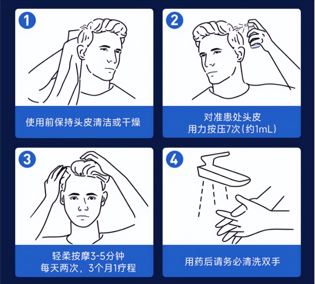 年纪轻轻用上了米诺地尔,年纪轻轻头发就秃了