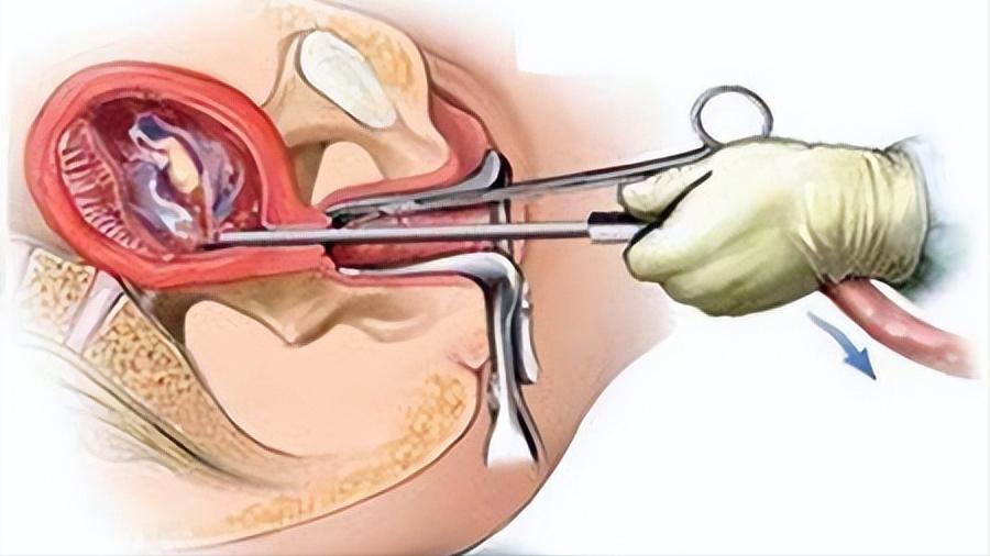 看到腺肌症,40岁女士顿悟了,终于明白自己为何例假痛得直打滚了