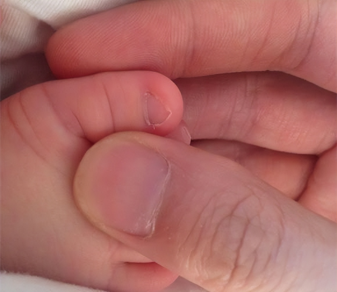 宝妈脚干裂怎么办,宝宝脚趾甲往肉里长怎么办