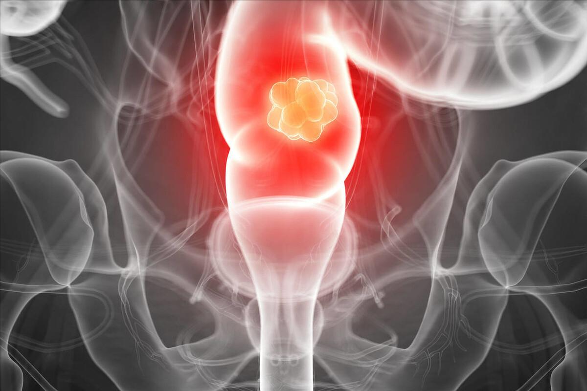 总感觉大便拉不干净，这是怎么回事？医生提醒：留意这3种病