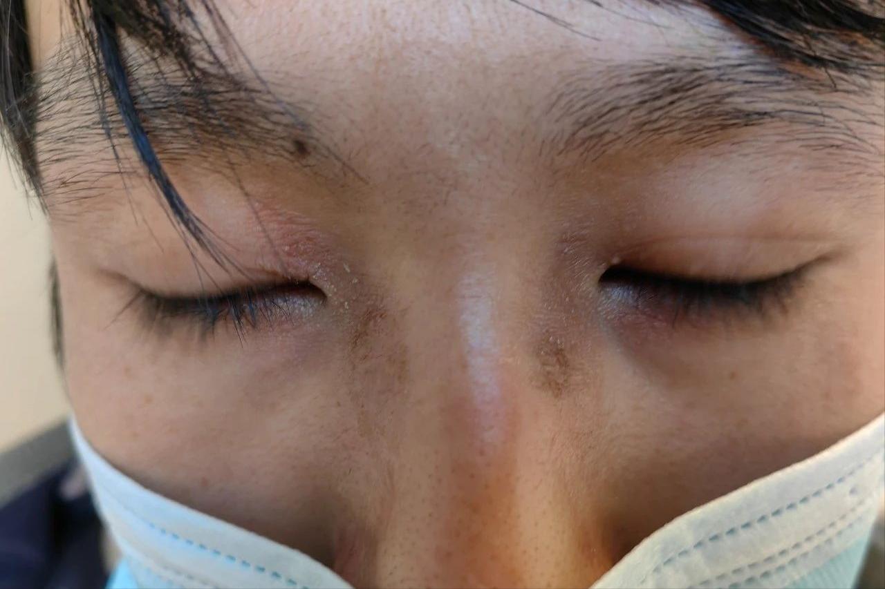 面部皮炎的症状和治疗方法,面部皮炎是怎么回事