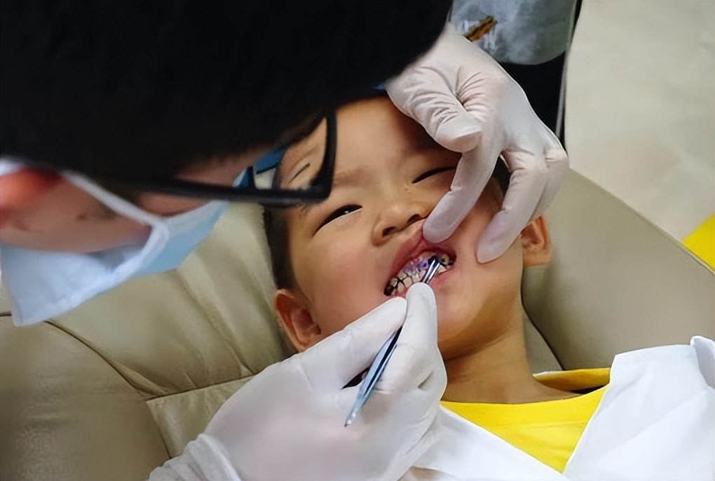 婴儿唇腭裂怎么护理,唇腭裂麻醉