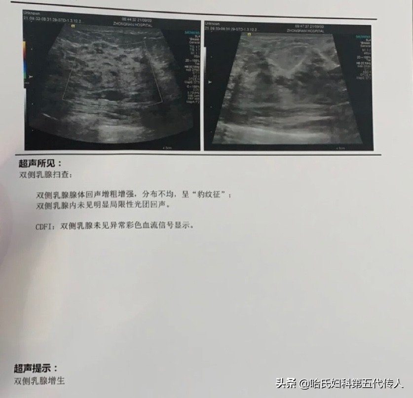 乳房经常胀痛乳腺增生用什么药好,乳腺增生吃清热散结胶囊有效吗