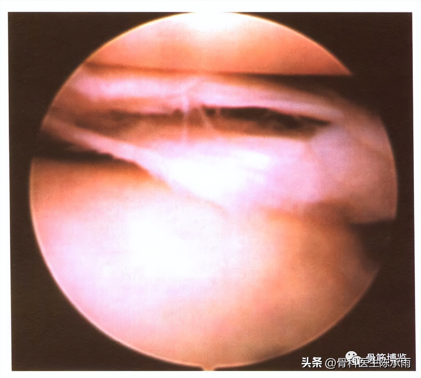 盘状半月板撕裂一级,半月板层裂愈合概率