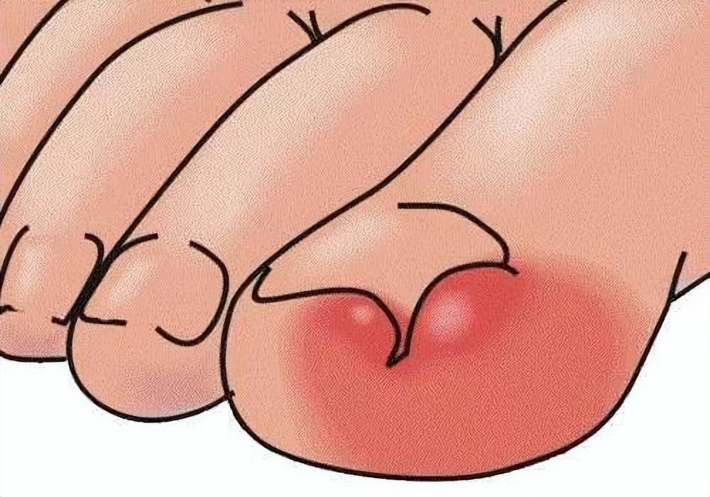 得了甲沟炎之后自己如何处理,得了甲沟炎怎么正确处理