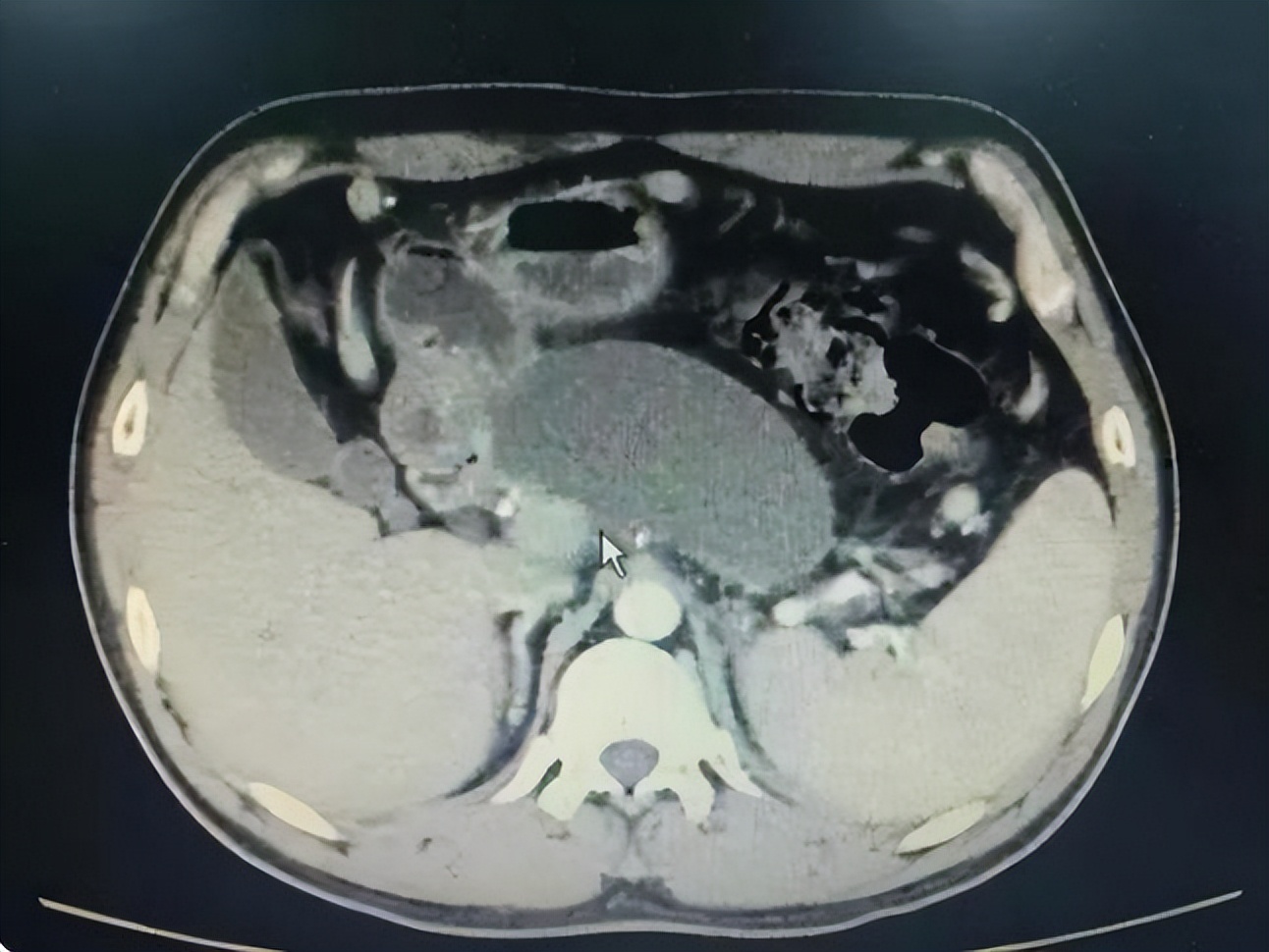 医生说有小囊肿要注意什么,囊肿刚开始长有什么办法消除吗