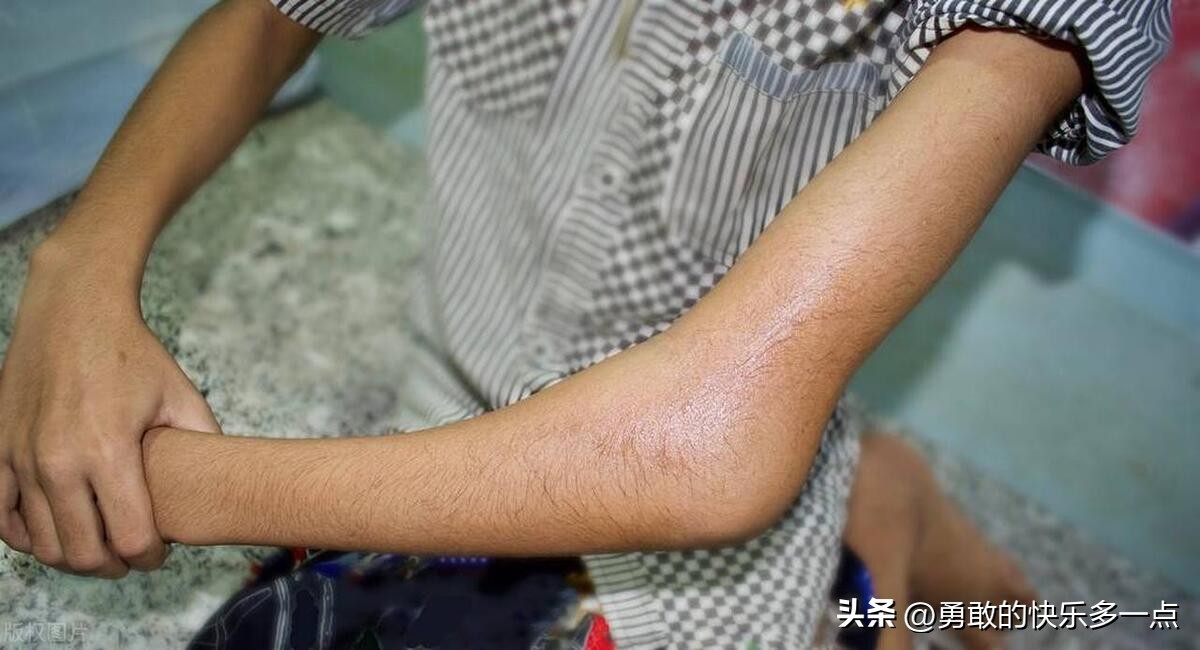 肱骨髁上骨折,肱骨髁上骨折图