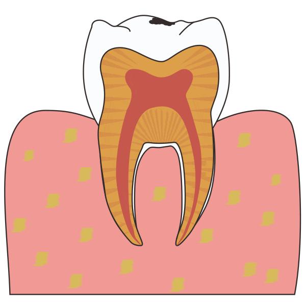 补牙后还会牙痛是正常的吗,补牙后会继续烂牙吗