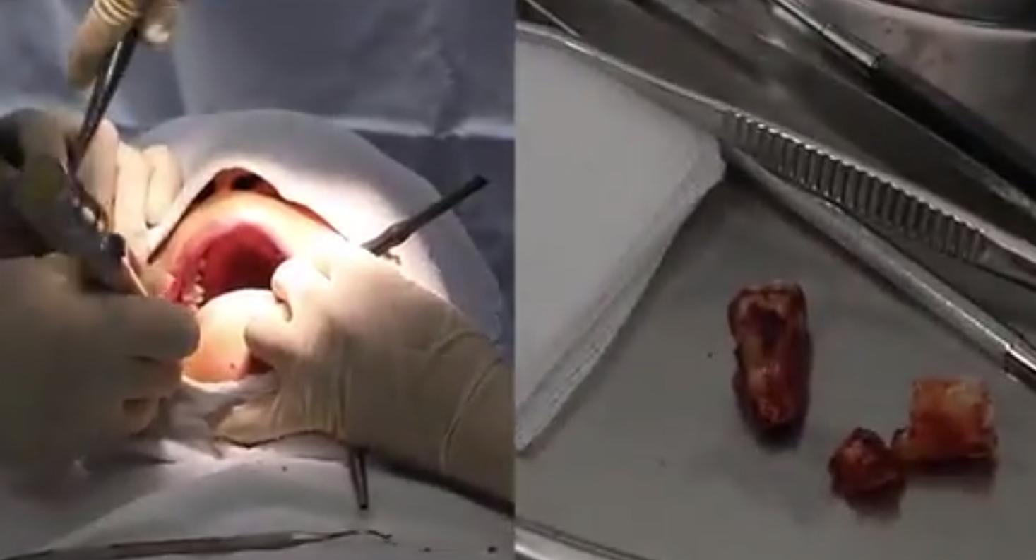 拔牙后一阵一阵的疼是干槽症吗,干槽拔牙要当心3个并发症