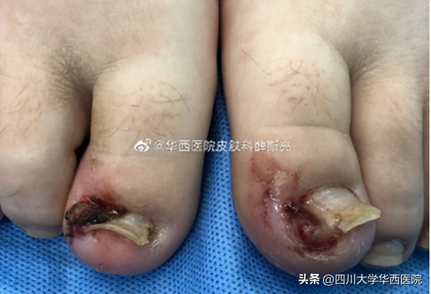 华西专家说，不是转你们，起码有一半的人从没有剪对过指甲儿！